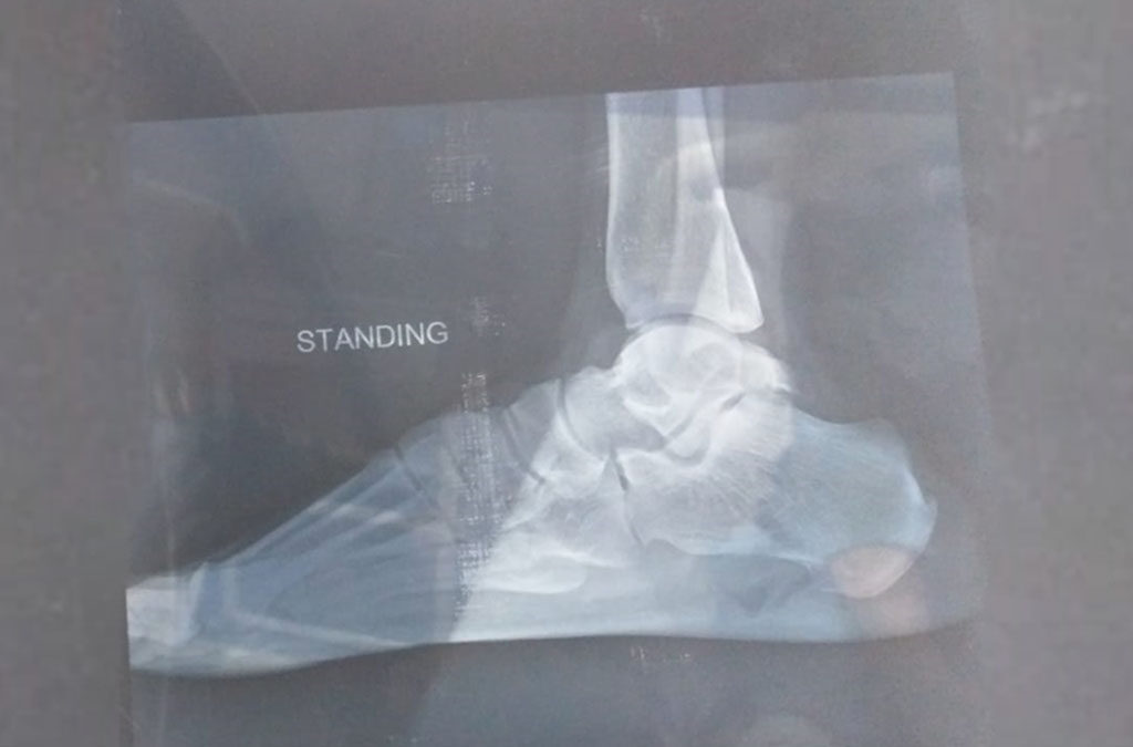 Management Of Talus Fracture The Meer's Physiotherapy and Rehabilitation